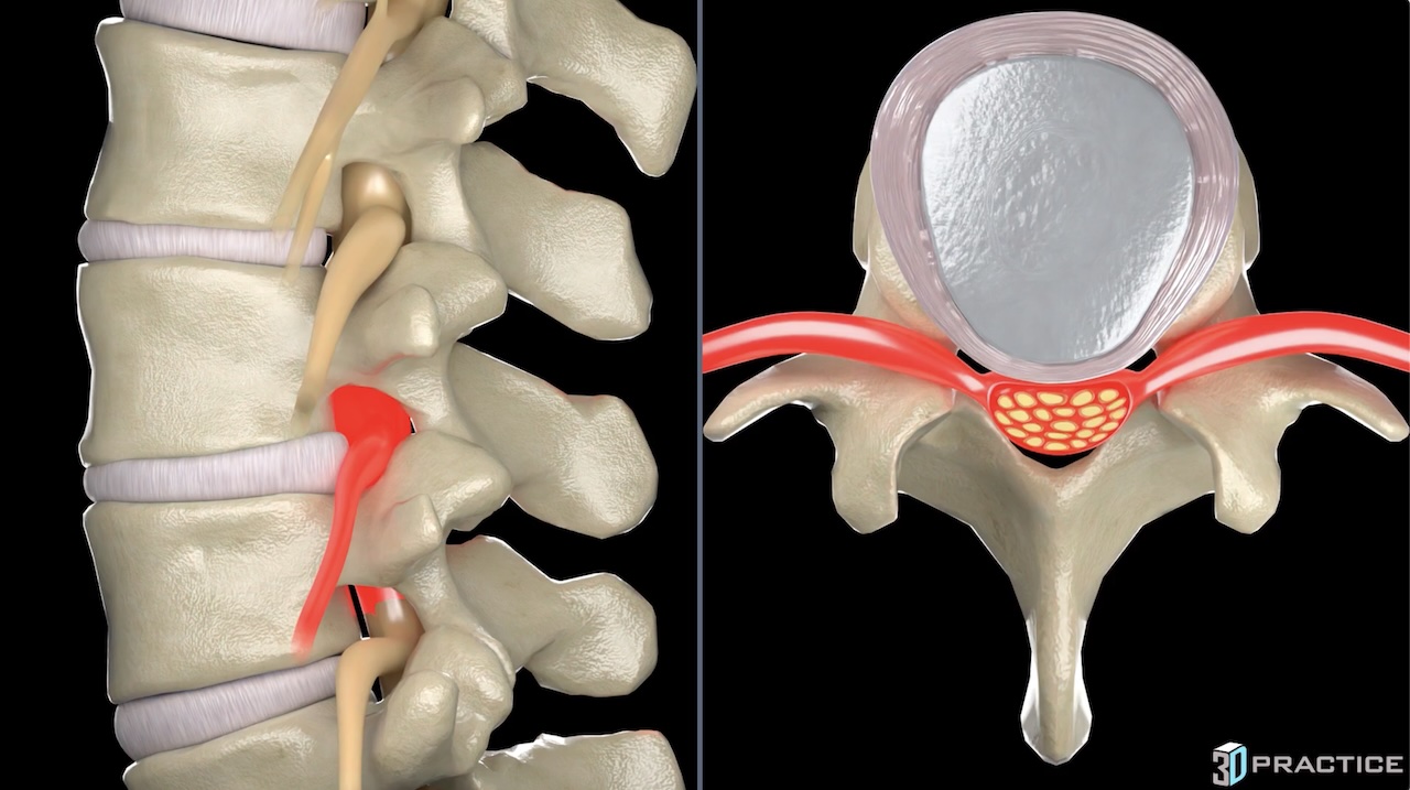 Lumbar Central Bulge