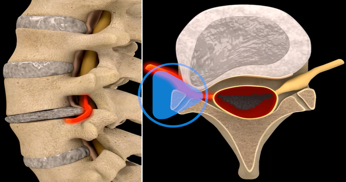 Lumbar - Left Bulge