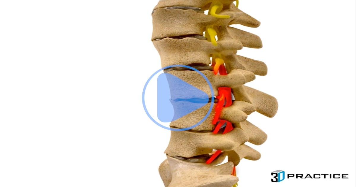 Lumbar Degeneration
